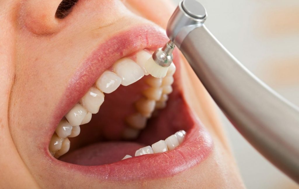 dental-cleaning-in-colombia