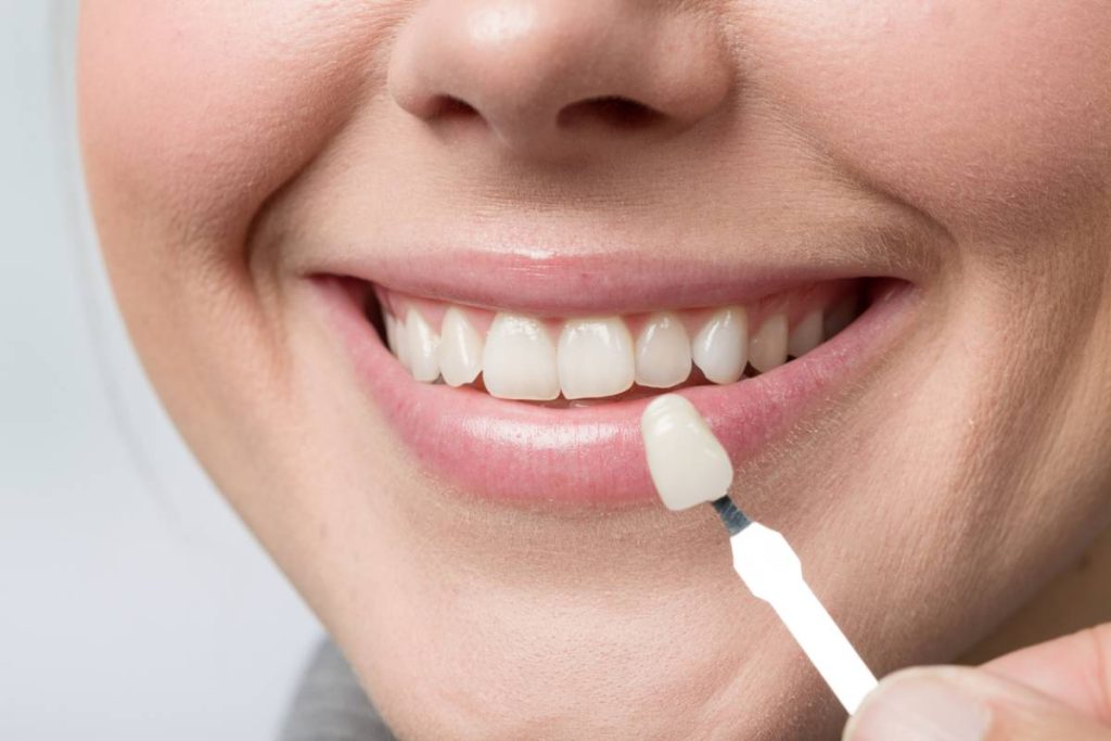 porcelain-veneers-in-colombia