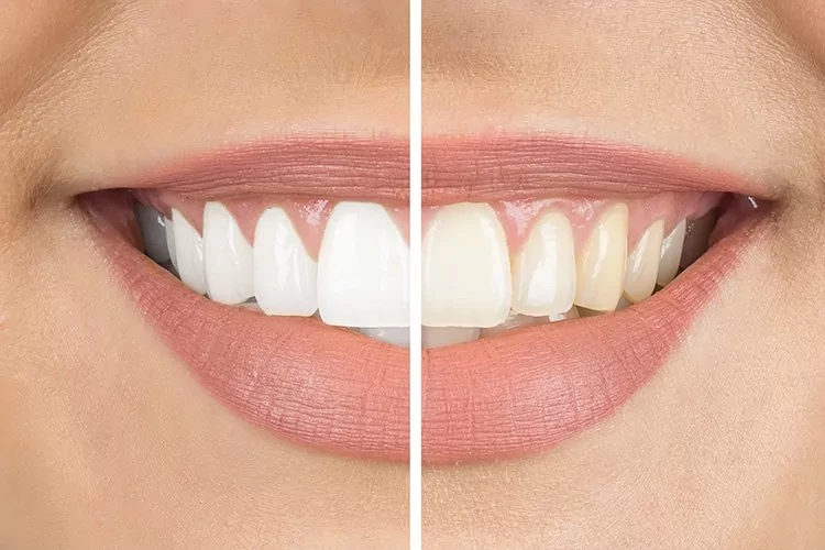 teeth-whitening-in-colombia